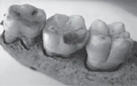 Abb 13 Mittelalterlicher Skelettfund a vermutlich bestehende MIH an der - фото 9