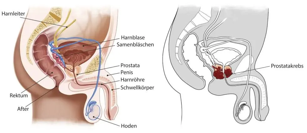 Abb 1 Gesunde Prostata links und Prostatakrebs rechts Als Drüse - фото 1