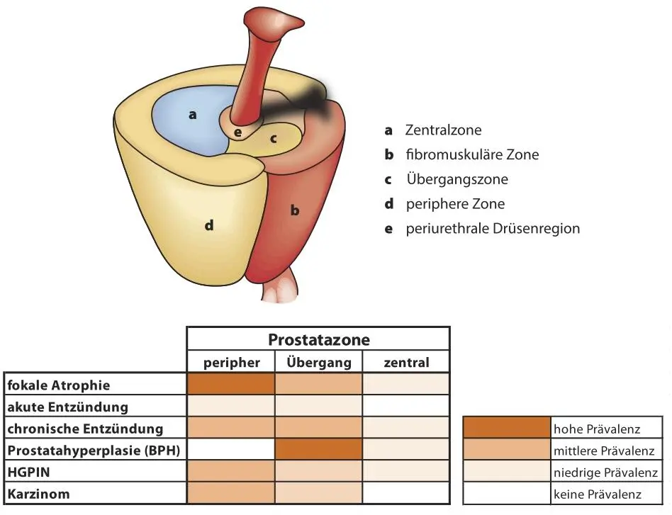 Abb 2 Prädisposition der Prostatazonen für Prostataerkrankungen nach De - фото 2
