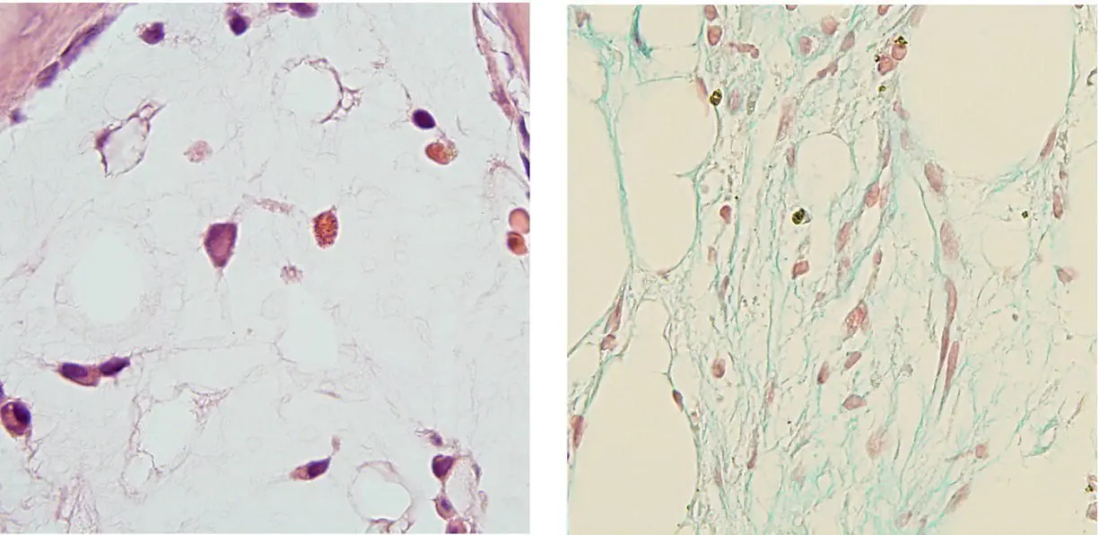 Typically this condition involves the marrow diffusely above left HE and - фото 22
