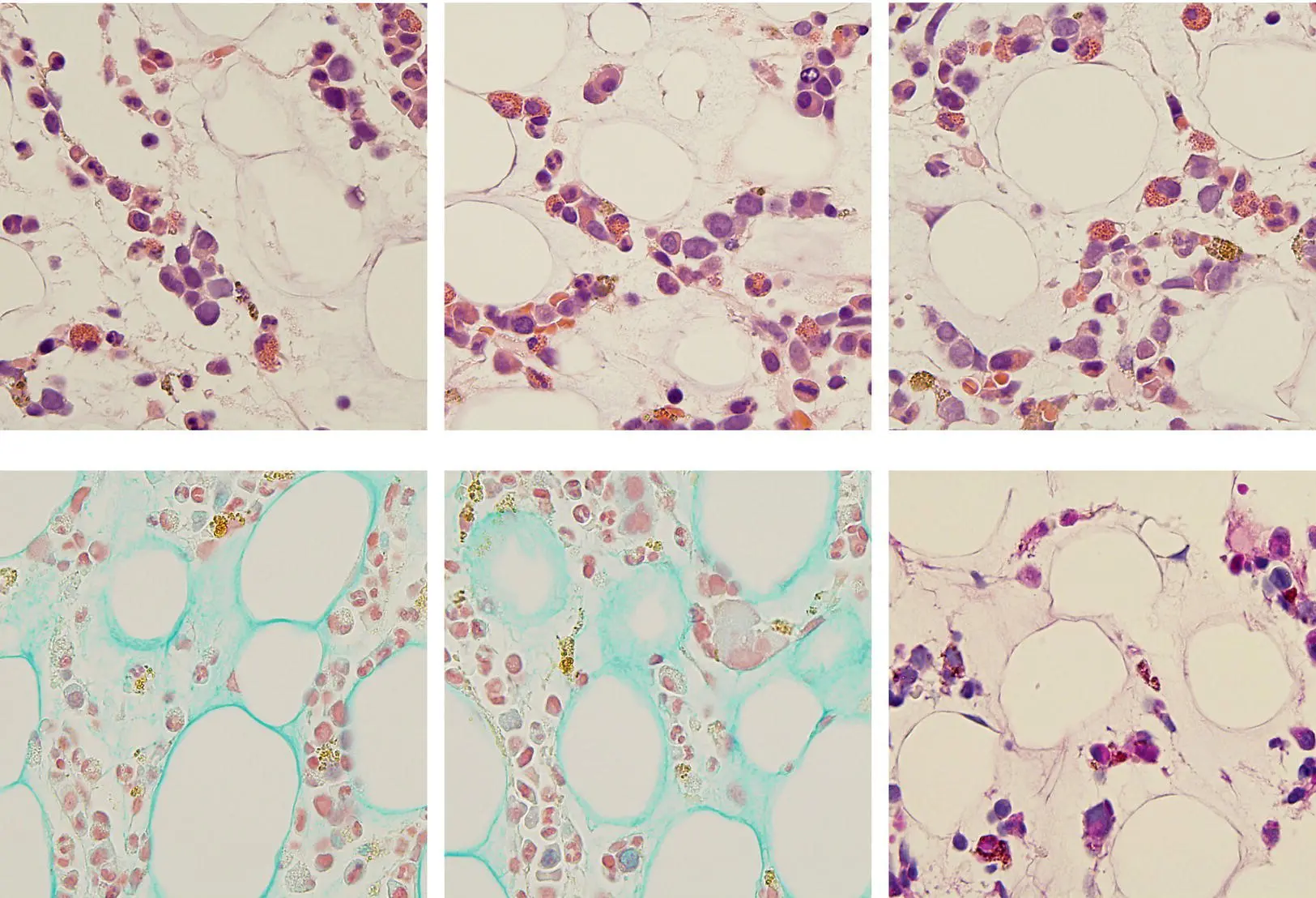 A 60yearold man with chronic debility due to neurosarcoidosis was referred - фото 21