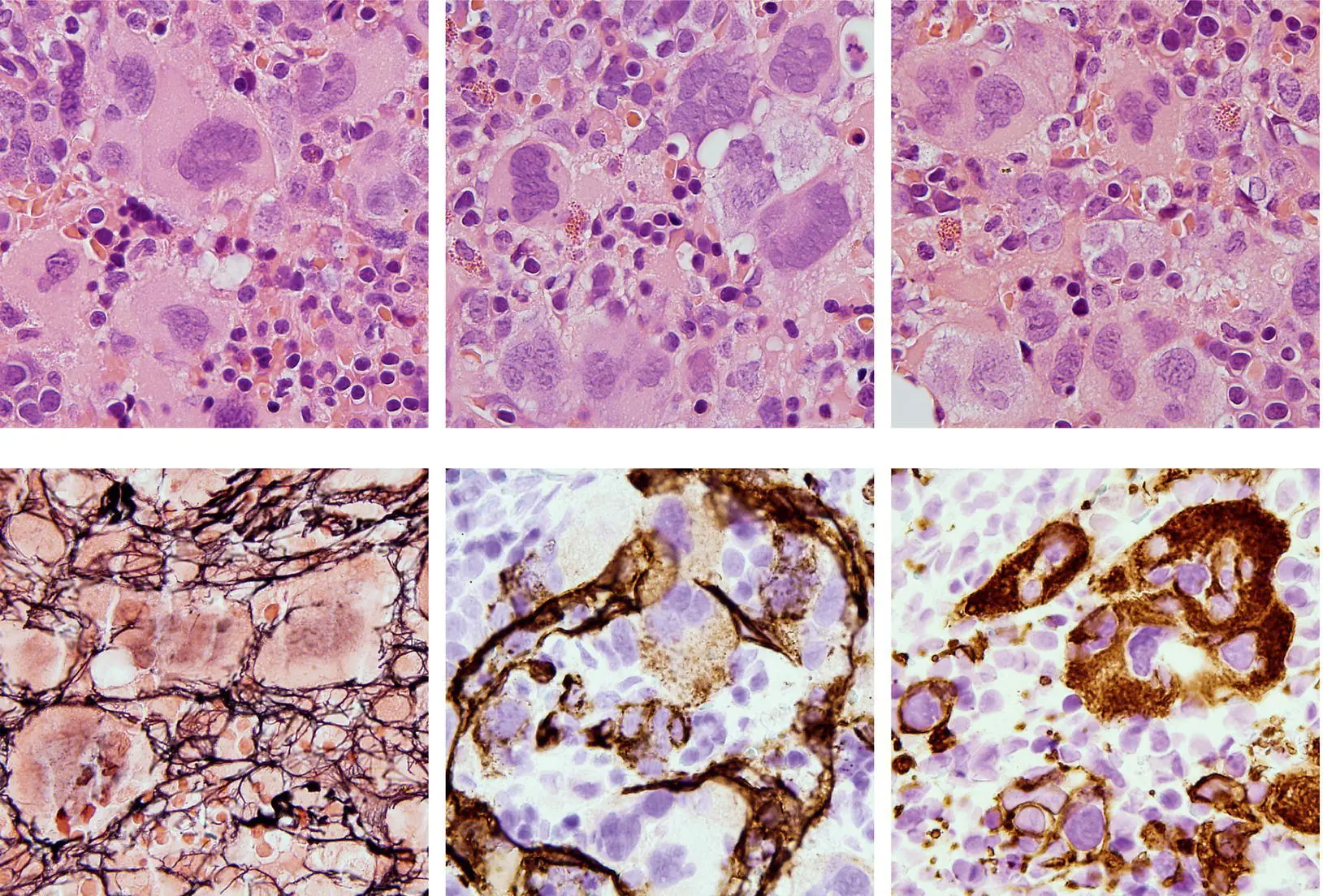 A 40yearold man underwent allogeneic stem cell transplantation for JAK2 - фото 15