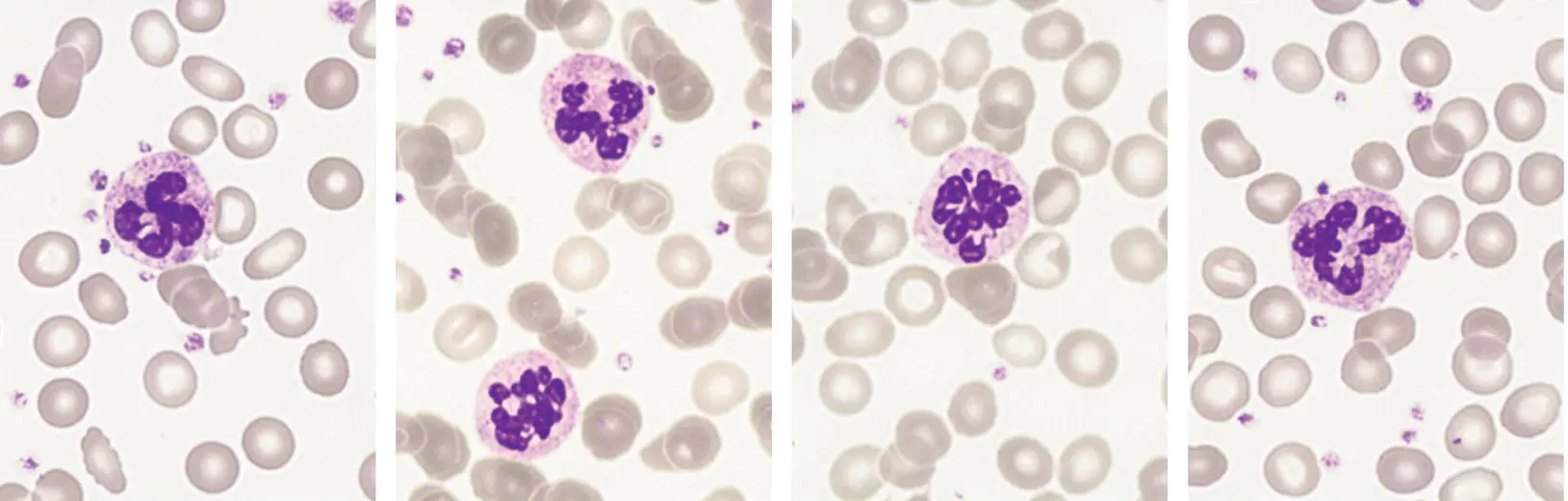 Other features of MDS include detached nuclear fragments ring nuclei and - фото 14