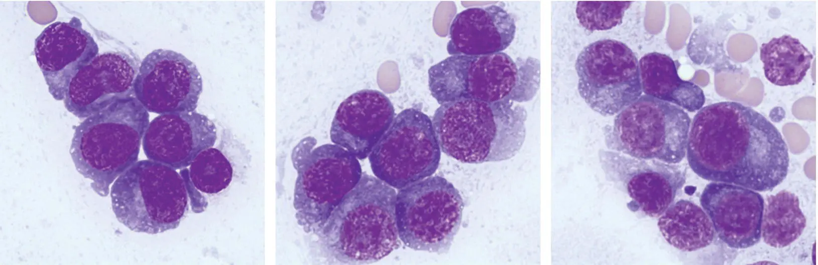A 76yearold woman treated with multiple lines of therapy for multiple myeloma - фото 28