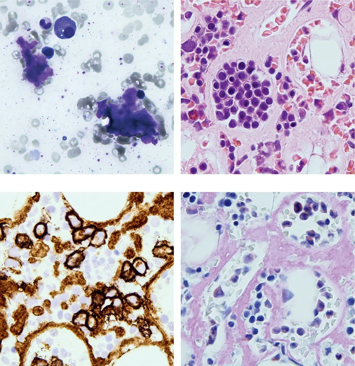 A 47yearold man presented with peripheral oedema due to nephrotic syndrome - фото 4
