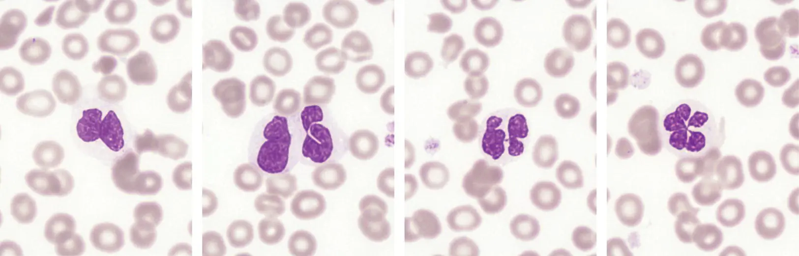 The images above show more examples of abnormal nuclear segmentation in MDS in - фото 8
