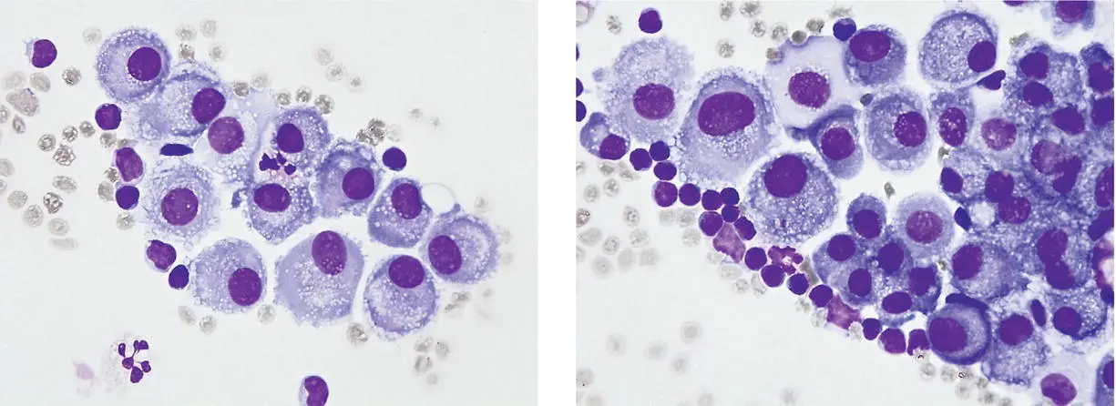 A 53yearold woman presented with chest pain and dyspnoea On CT imaging a - фото 26