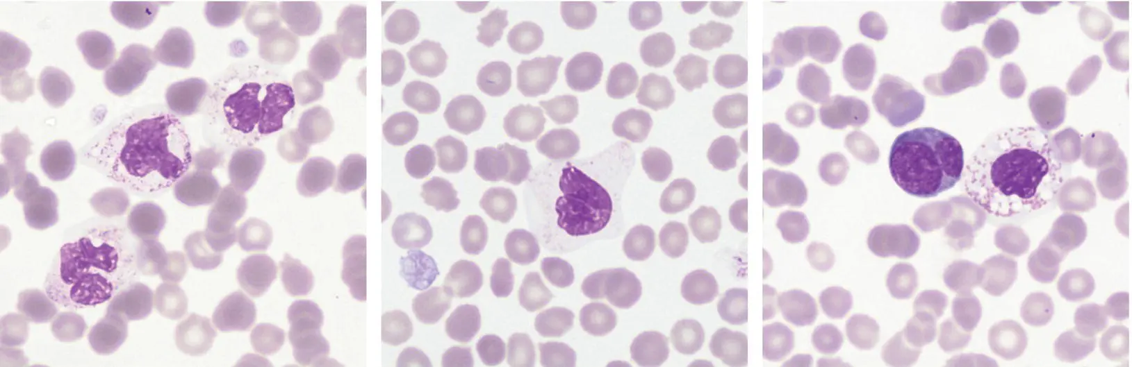 The images above 100 objective show hypogranular and vacuolated eosinophils - фото 47