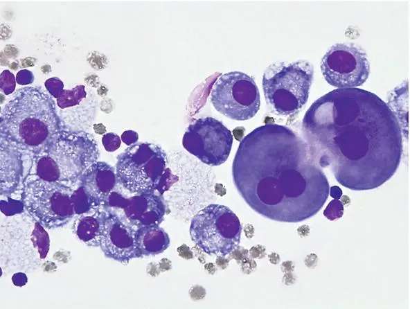 Mesothelial cells are often seen in pleural and ascitic taps They are shed - фото 27