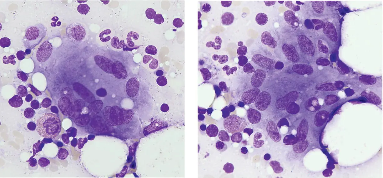 MCQ 1 Caseating granulomas can be a feature ofFungal infectionGranulomatous - фото 18