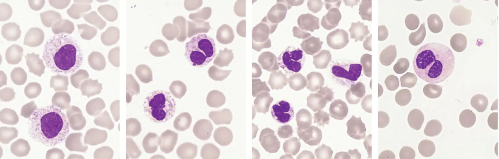 Importantly changes in neutrophil morphology can be reactive in nature so the - фото 10