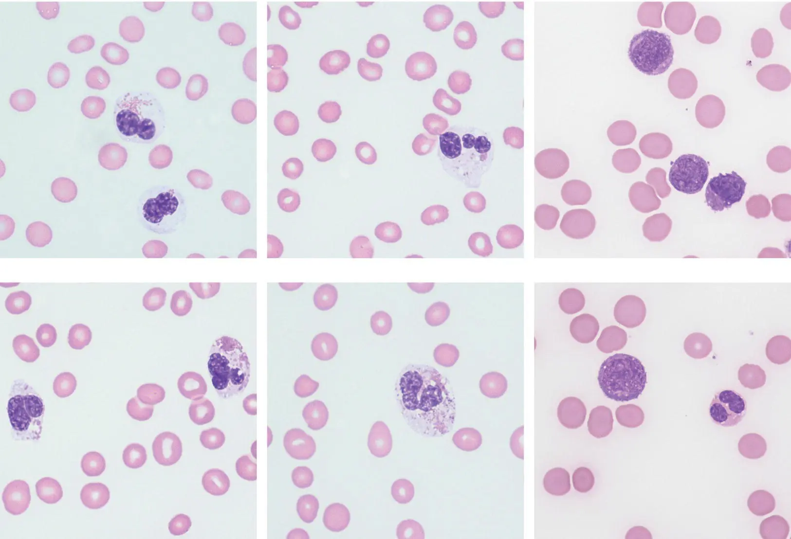 A 70yearold man developed therapyrelated acute myeloid leukaemia tAML - фото 46