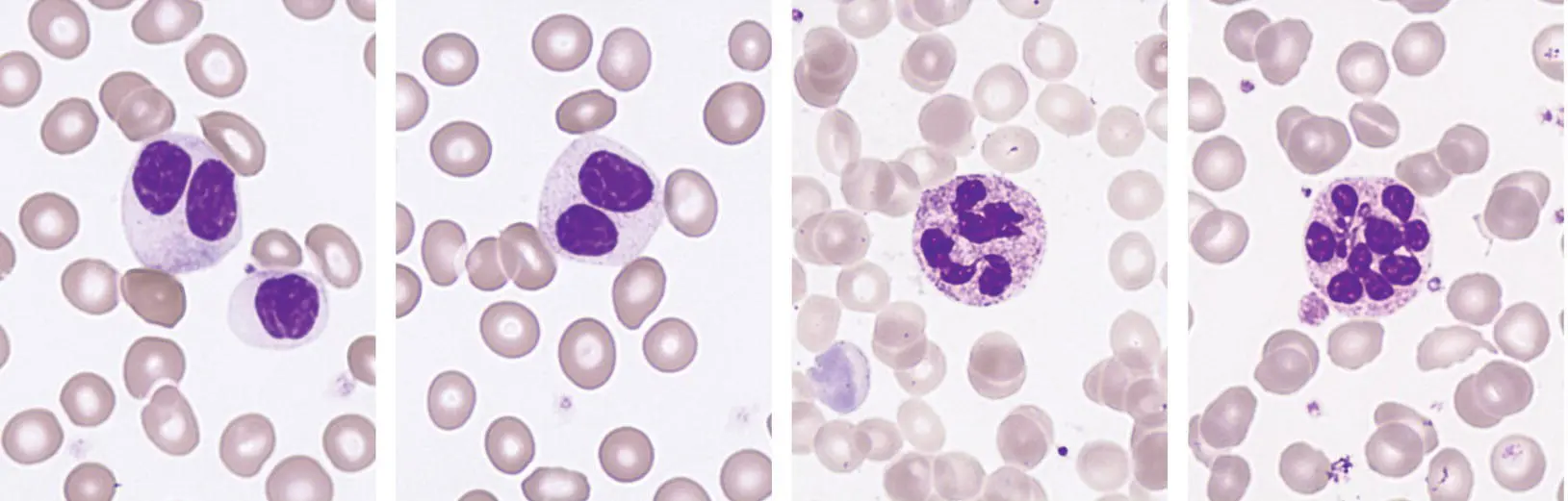 Other neutrophil abnormalities that can be found in MDS include binucleated - фото 13