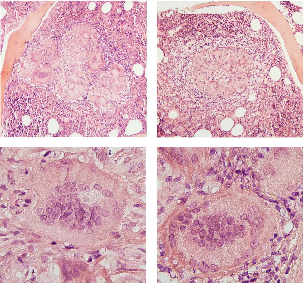 A 50yearold man was referred for investigation of lowvolume lymphadenopathy - фото 17