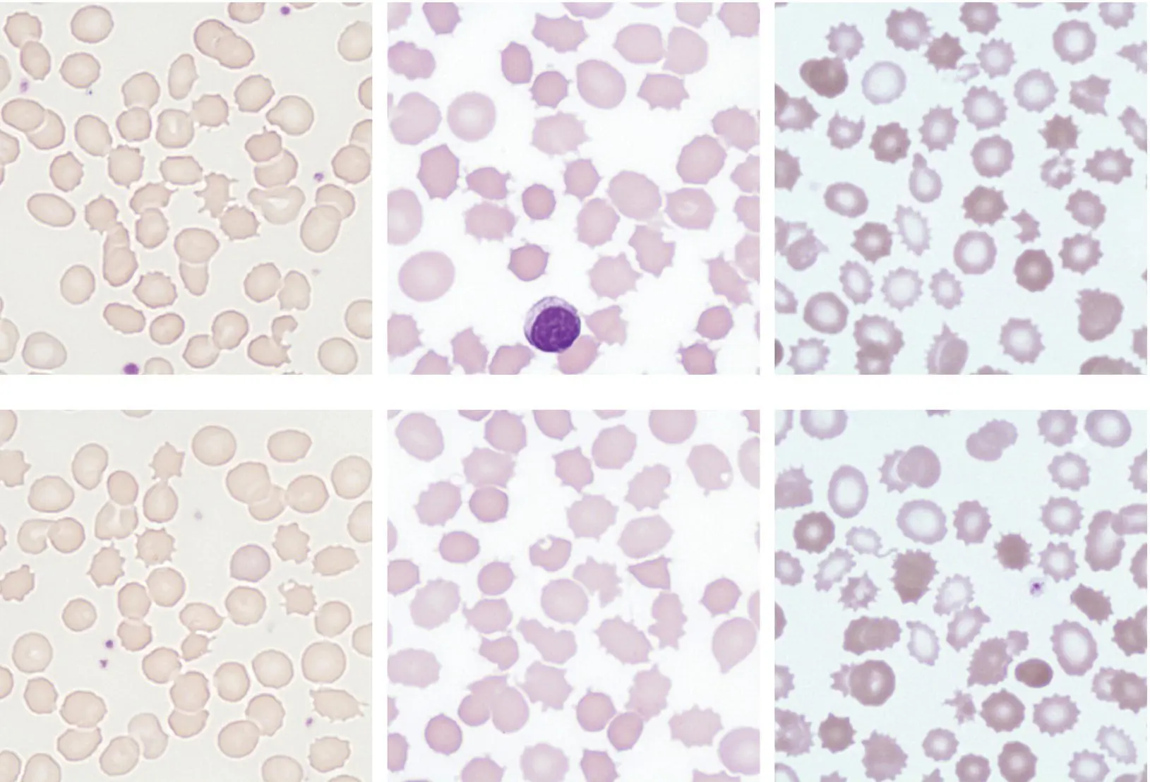 A 50yearold man with a progressive myopathy and cardiomyopathy was referred - фото 23