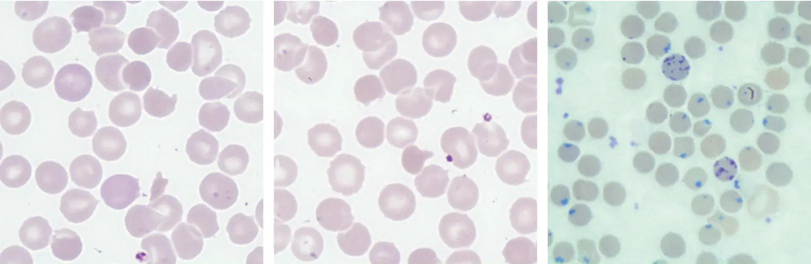 A 26yearold man was well known to the Haematology clinic and had a chronic - фото 31