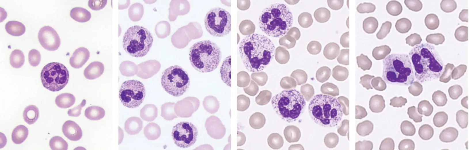 Neutrophil hypersegmentation can also be a feature of dysplasia but more - фото 11