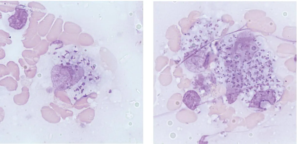 MCQ 1 Leishmaniasis involving the bone marrowCan be complicated by a - фото 20