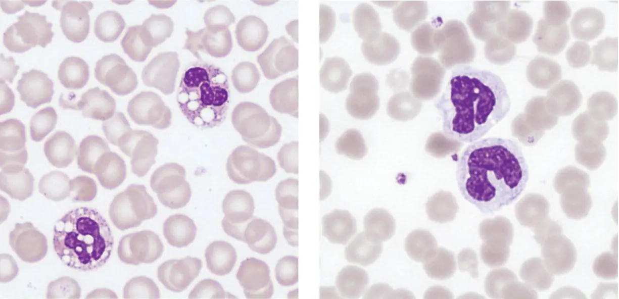 The left image above shows prominent neutrophil cytoplasmic vacuolation due - фото 12