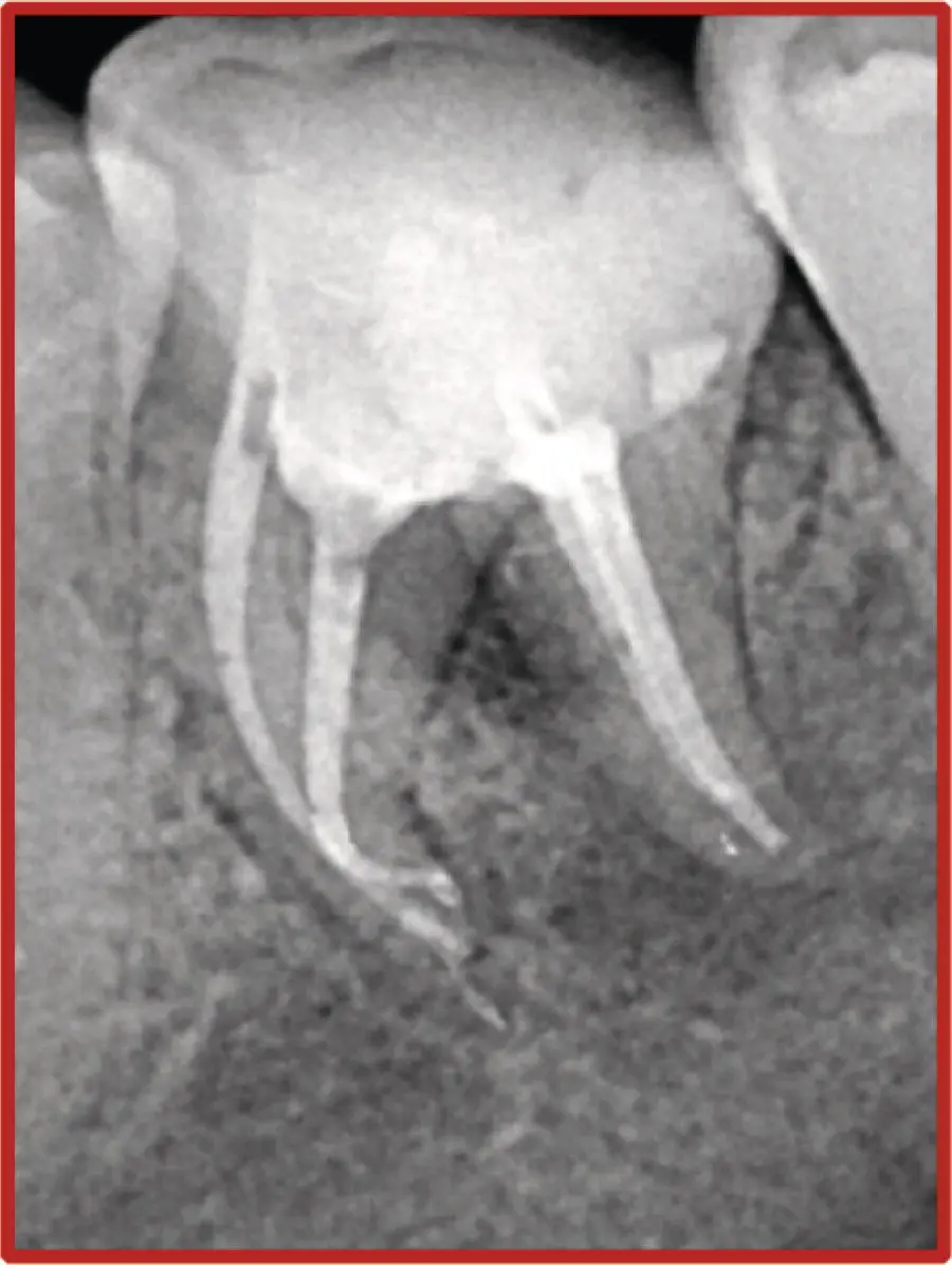 Figure 15 Radiograph showing obturation along with intact MTA Figure 16 - фото 4