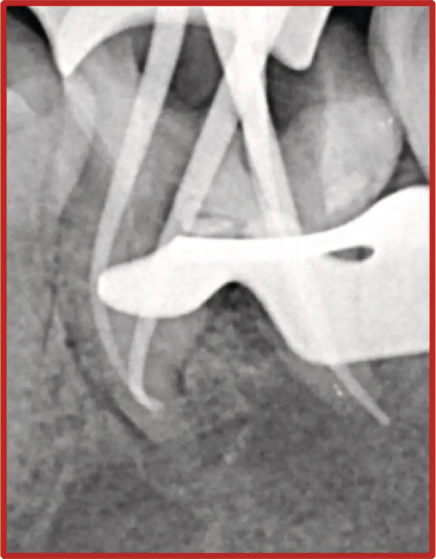 Figure 14 Radiograph showing master cone verification after biomechanical - фото 3