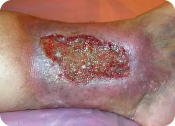 Figura 34 Úlcera venosa Tomada de Todo sobre heridas Úlceras venosas - фото 24