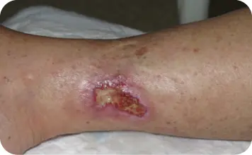 Figura 35 Úlcera de Martorell Tomada de Conde E Cuando una herida no - фото 25