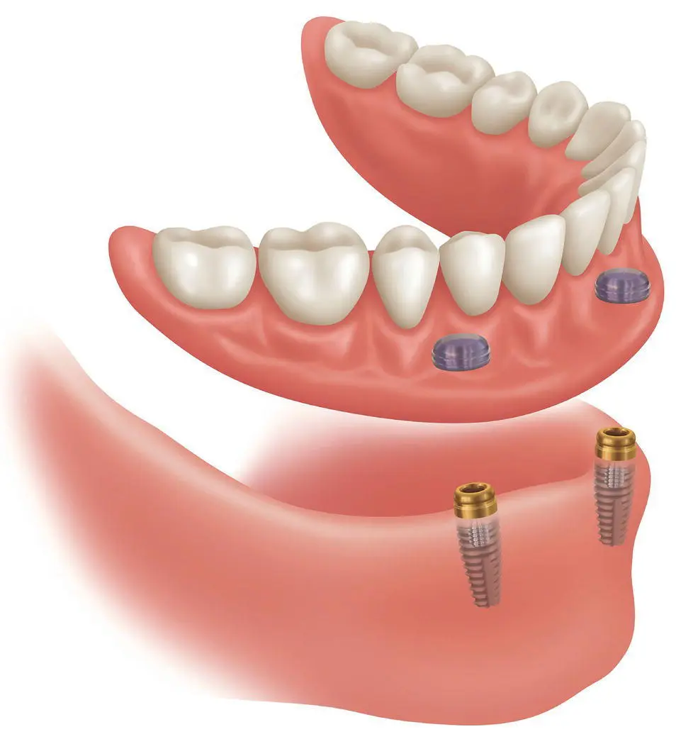 Figure 13Implantsupported overdenture Source Courtesy of Zest Anchor The - фото 4