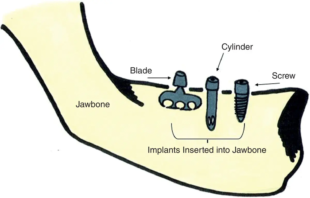 Figure 23Different types of implants Figure 24Modern screwtype implant - фото 7