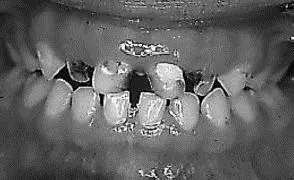 Figura 23 Apertura bucal la cual debe ser mayor a 4 cm para predecir una - фото 10