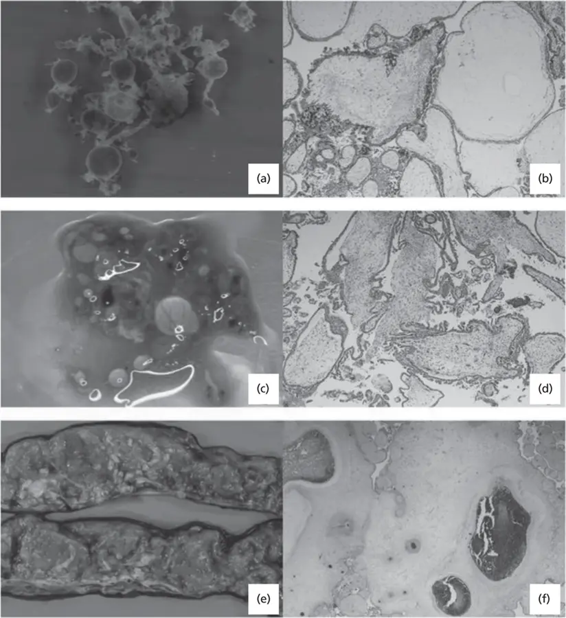 Figure 41 a Complete hydatidiform mole CHM gross cystic villi b CHM - фото 21