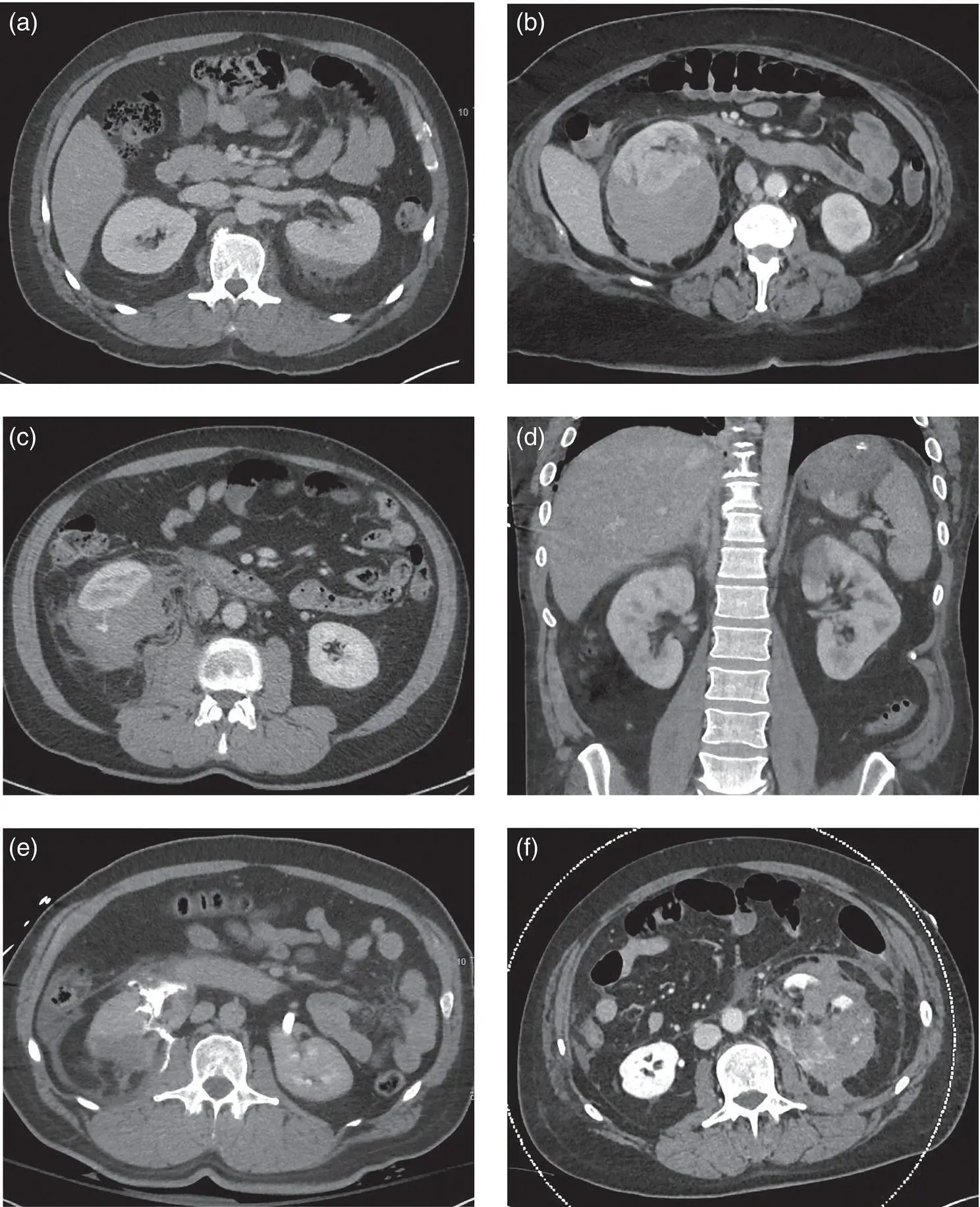 Figure 12 CT images of renal injuries including a axial view of a left - фото 3
