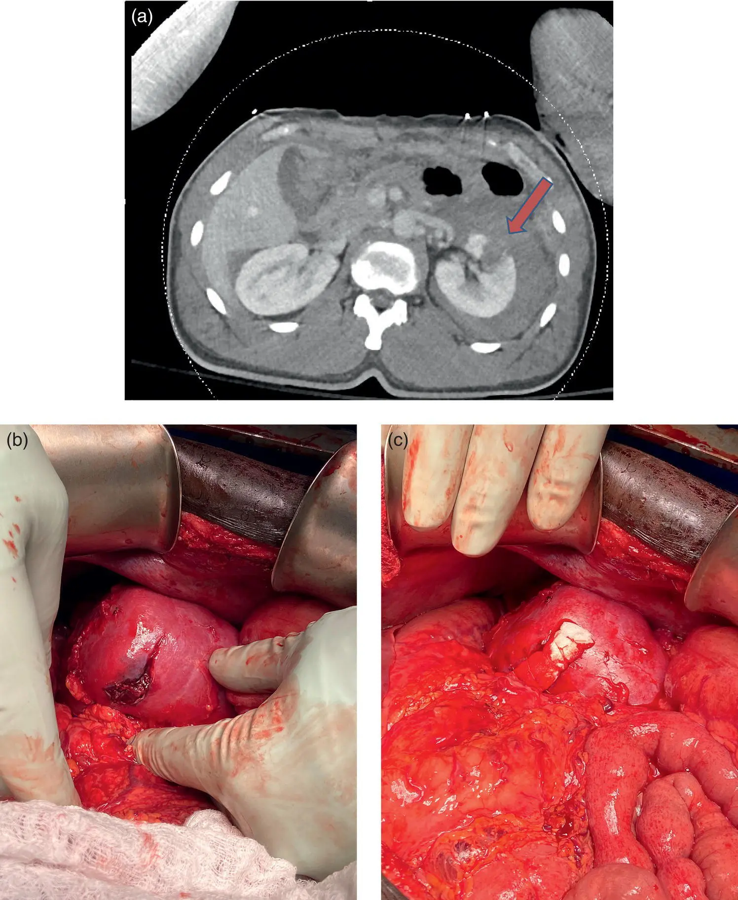 Figure 26 Fortyfouryearold male who sustained a GSW with a grade III left - фото 12