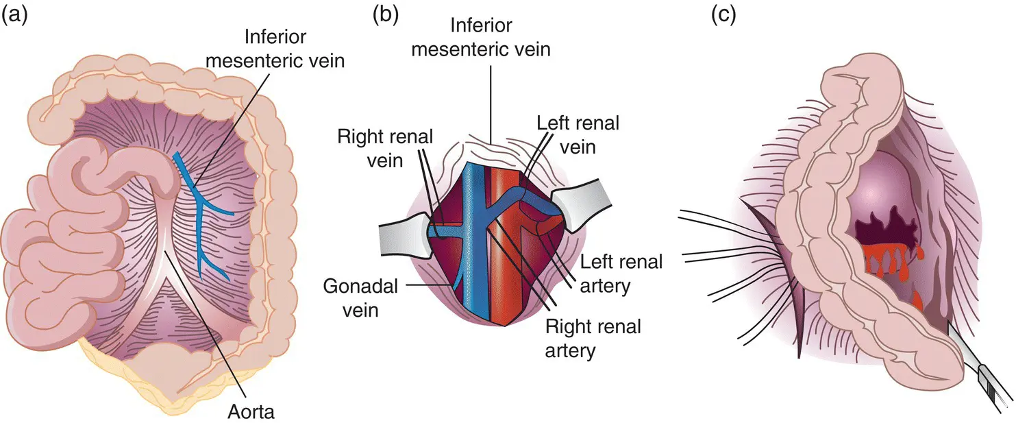 Figure 14 Surgical approach to renal vessels and hilum a Relationship - фото 5