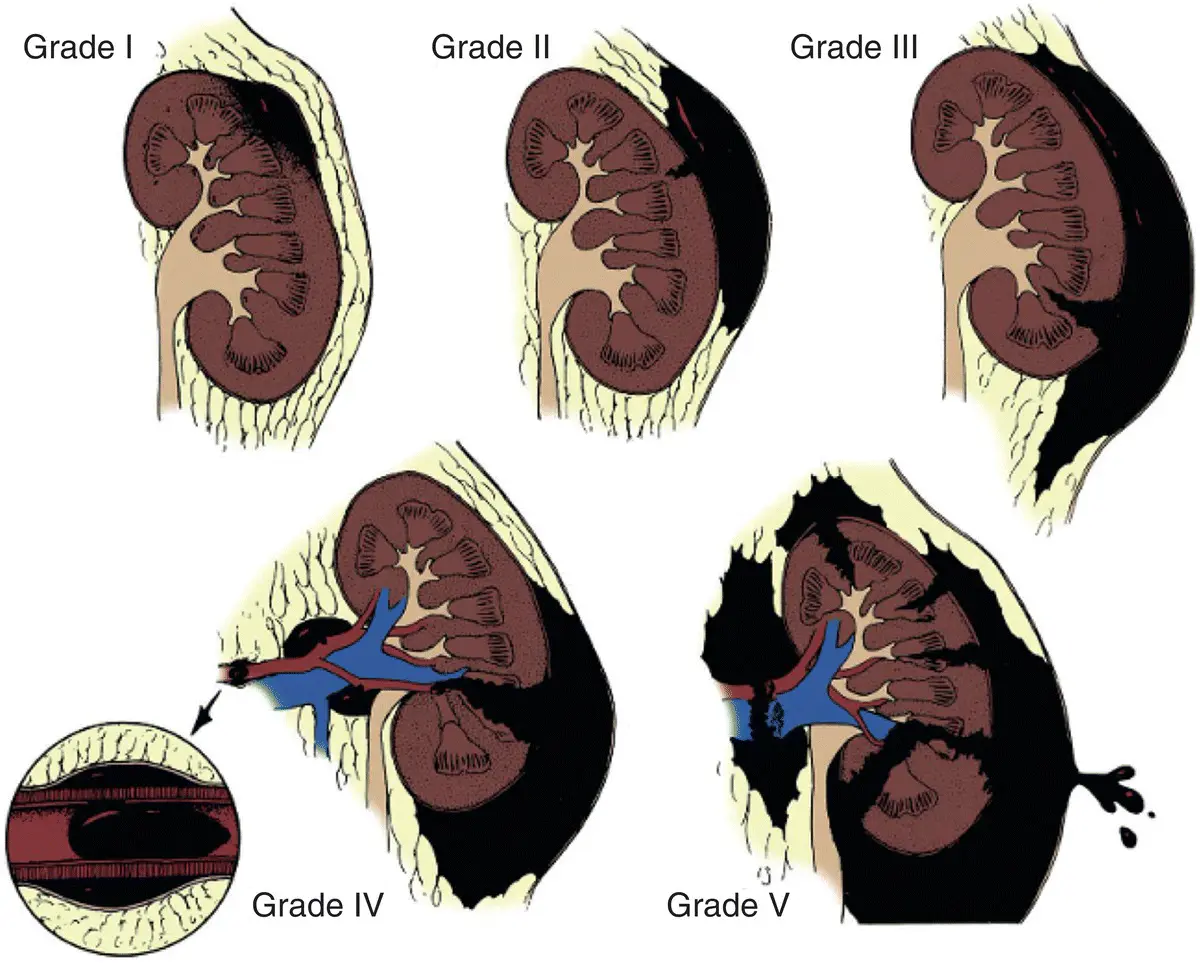 Figure 11 American Association for the Surgery of Trauma AAST Organ Injury - фото 2