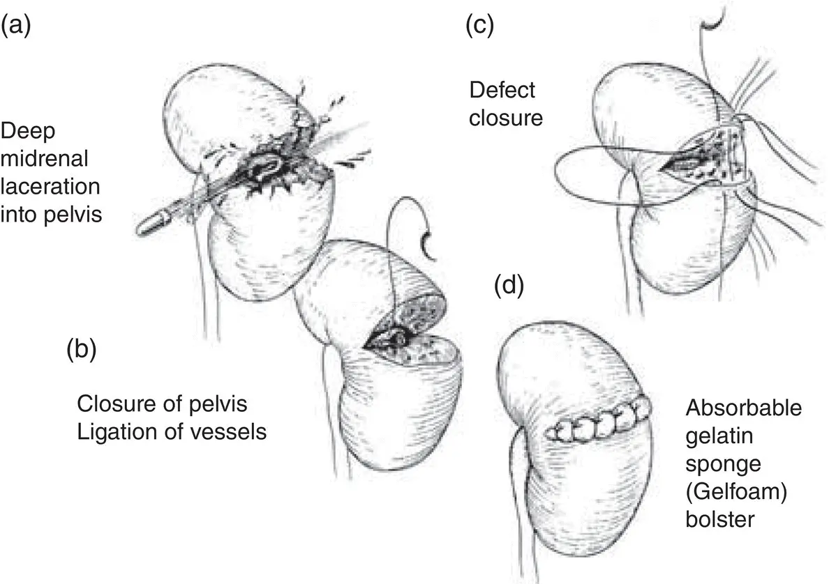 Figure 25Renorrhaphy a Deep midrenal laceration into pelvis Basic - фото 11