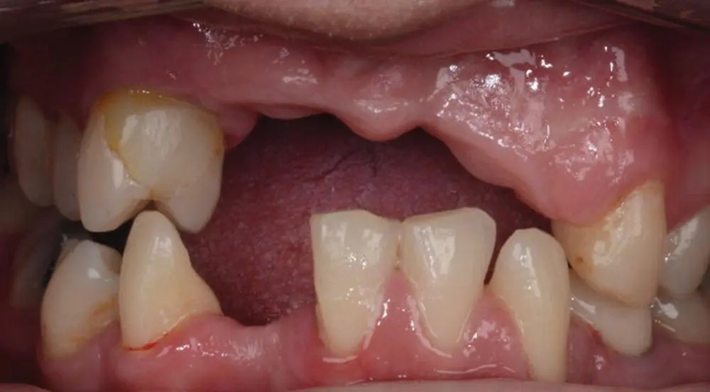 Figure 15 Dental trauma caused by a road traffic accident presenting 2 years - фото 9