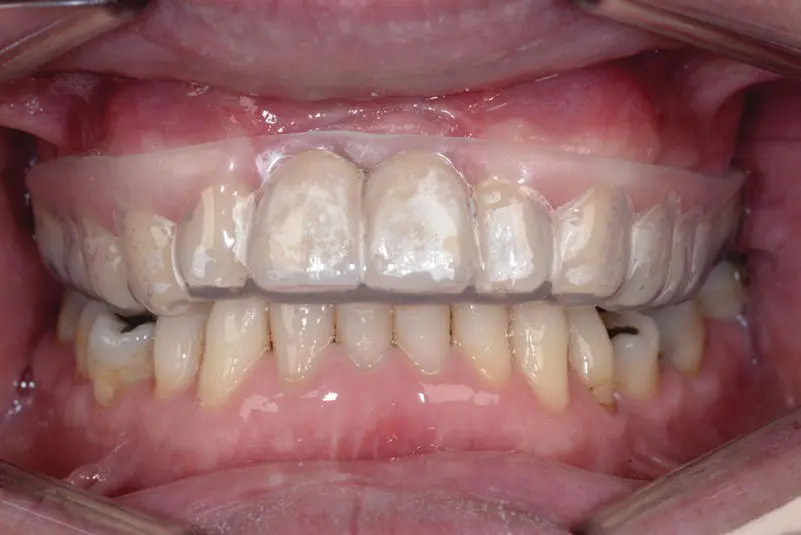 Figure 23 An incorrectly extended maxillary mouth guard not covering the soft - фото 12
