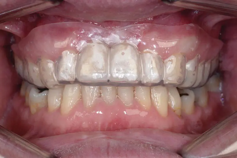 Figure 22 A correctly extended maxillary mouth guard covering the teeth and - фото 11