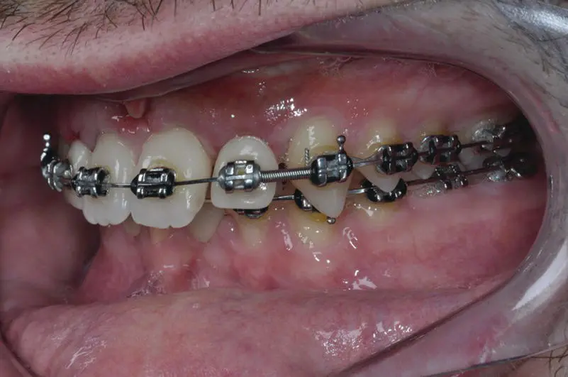 Figure 25 Orthodontics reducing an increased overjet Introduction The - фото 14