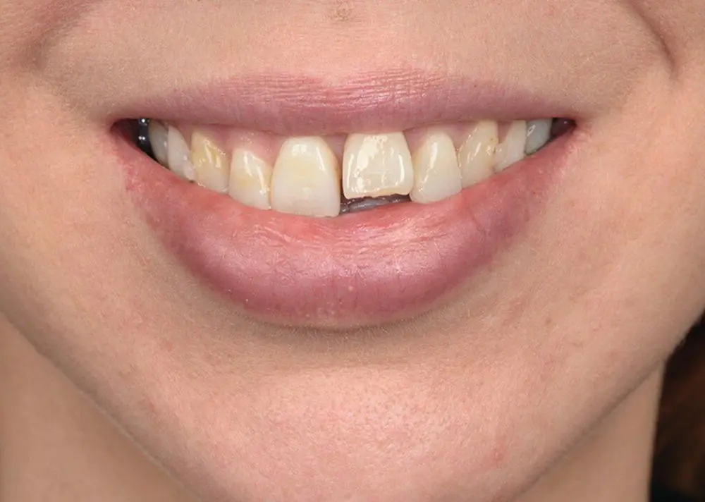 Figure 12 Lower lip trapped behind the maxillary incisor Figure 13 A - фото 6