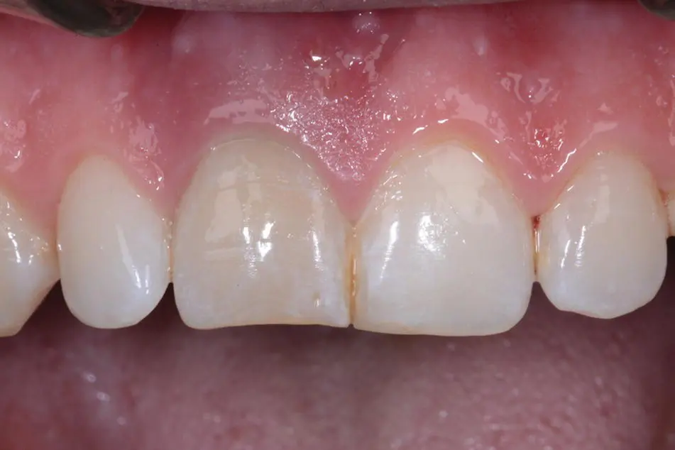 Figure 14 Dental trauma caused by sporting activities in this case boxing - фото 8