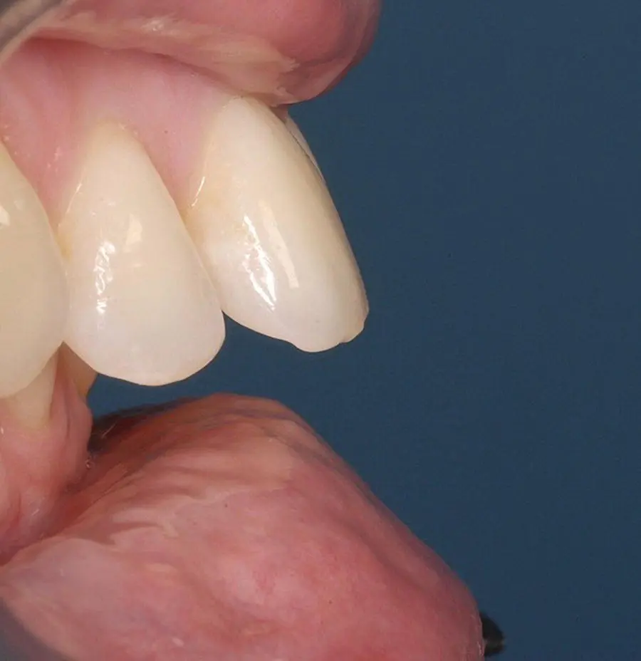 Figure 11 Demonstration of a 6mm overjet Figure 12 Lower lip trapped - фото 5