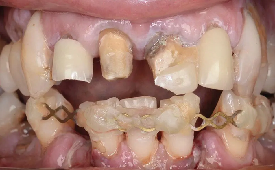 Figure 13 A heavily restored dentition following dental trauma with numerous - фото 7