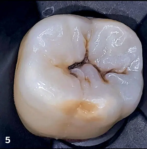 FIGS 5 6Patients should know that sometimes a small black line on a tooth can - фото 11