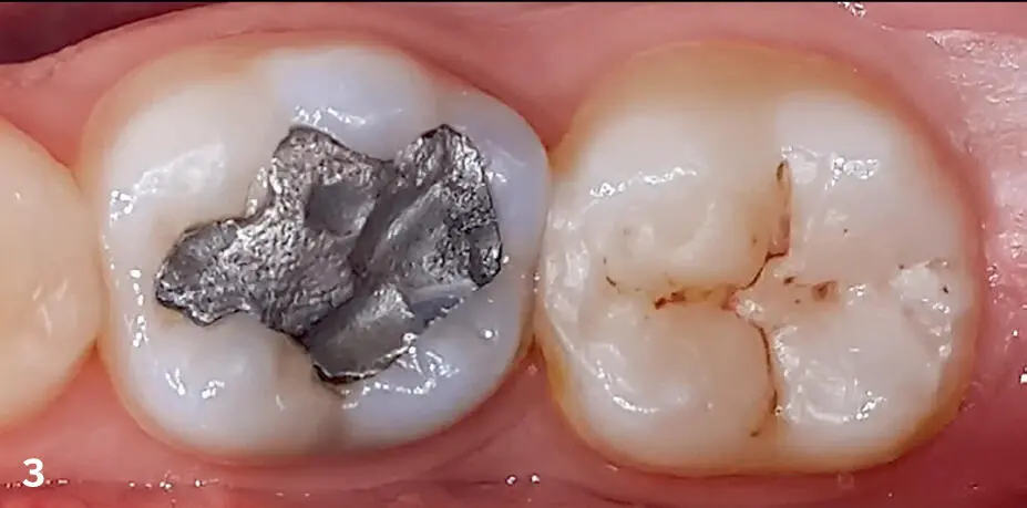 FIGS 3 4Before and 4 weeks after restoration of the first molar and 1 year - фото 9
