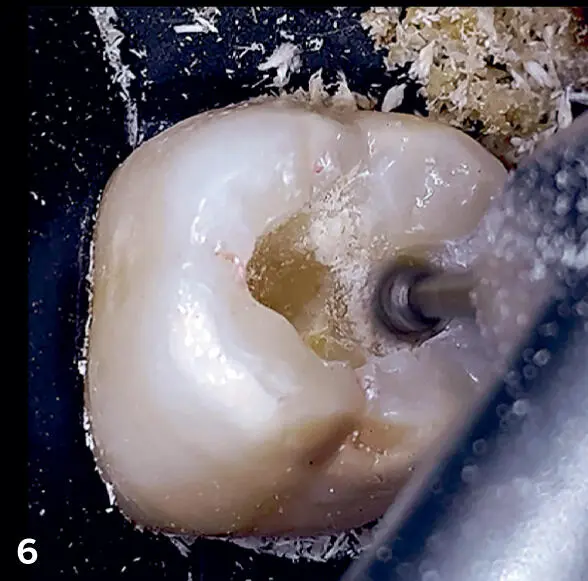 FIGS 5 6Patients should know that sometimes a small black line on a tooth can - фото 12