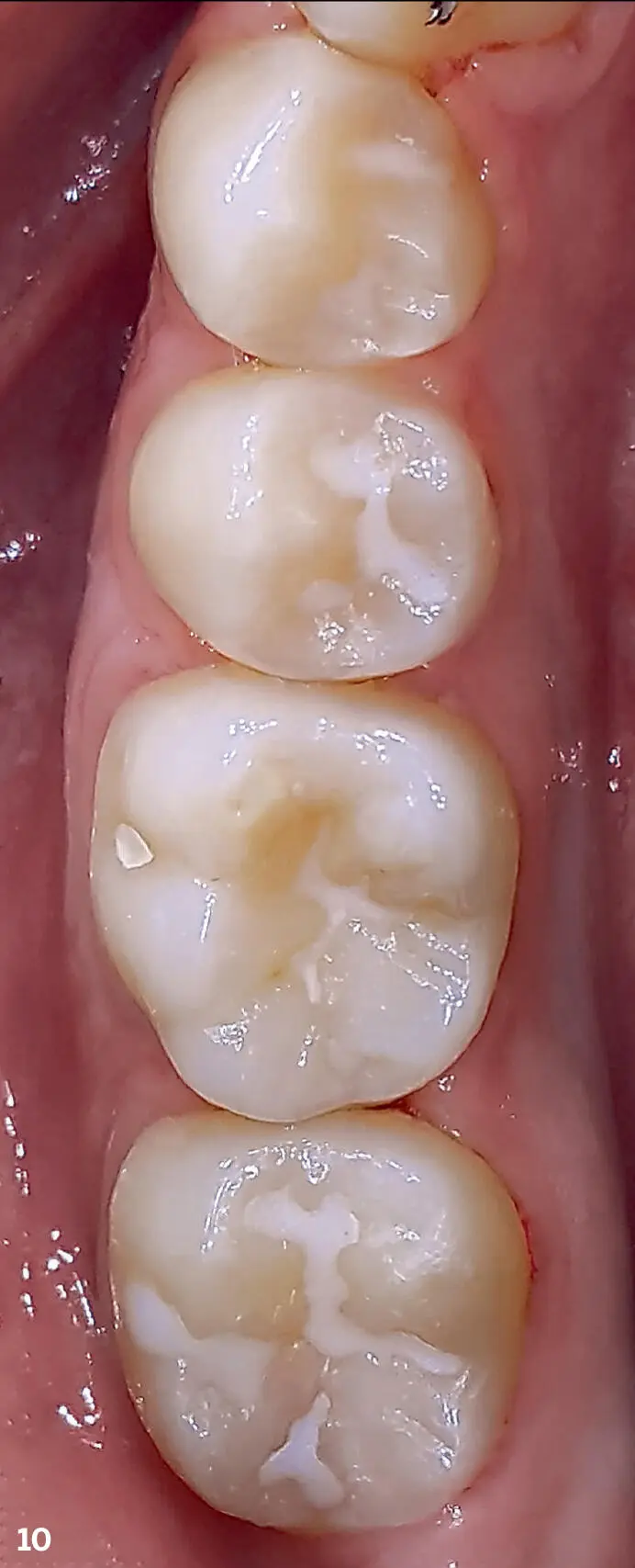 FIG 10Photographic documentation allows the dentist to see the evolution of the - фото 16