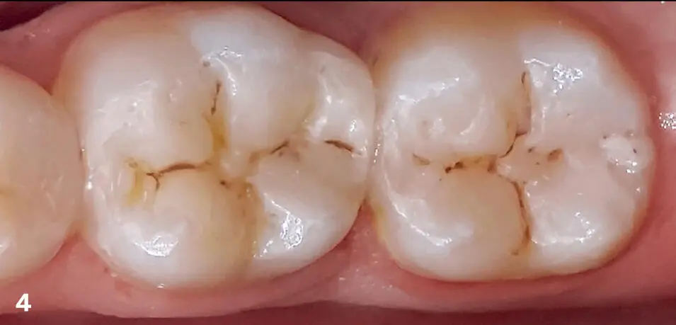 FIGS 3 4Before and 4 weeks after restoration of the first molar and 1 year - фото 10