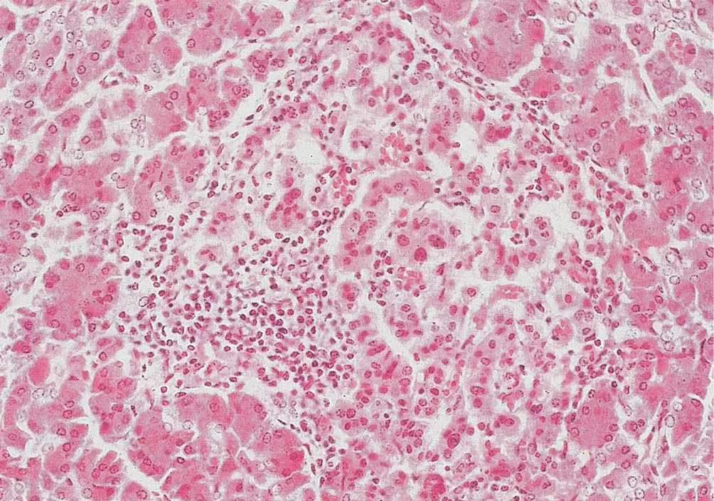 Figure 64 Insulitis There is a chronic inflammatory cell infiltrate centred - фото 56